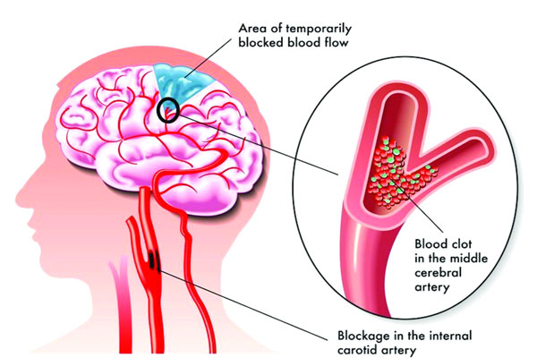 দৈনিক জনকন্ঠ || স্ট্রোক কেন হয়, কীভাবে হয়?