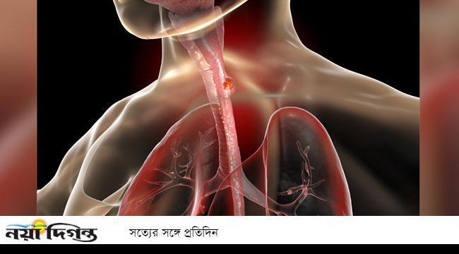 খাদ্যনালীর ক্যান্সার : লক্ষণ ও প্রতিকার