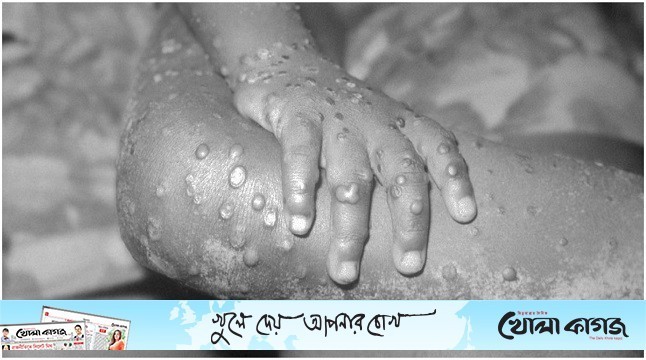 যেভাবে ছড়ায় মাঙ্কিপক্স