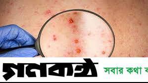 যেভাবে ছড়ায় মাঙ্কিপক্স