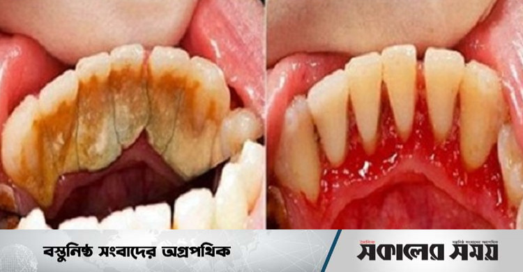 দাঁতে জমে থাকা প্লাক দূর করার ঘরোয়া ৫ উপায় | সকালের সময়