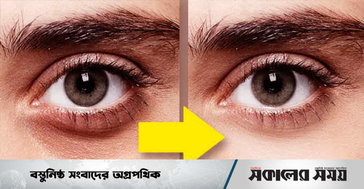 সহজে দূর করুন চোখের নিচের কালো দাগ | সকালের সময়
