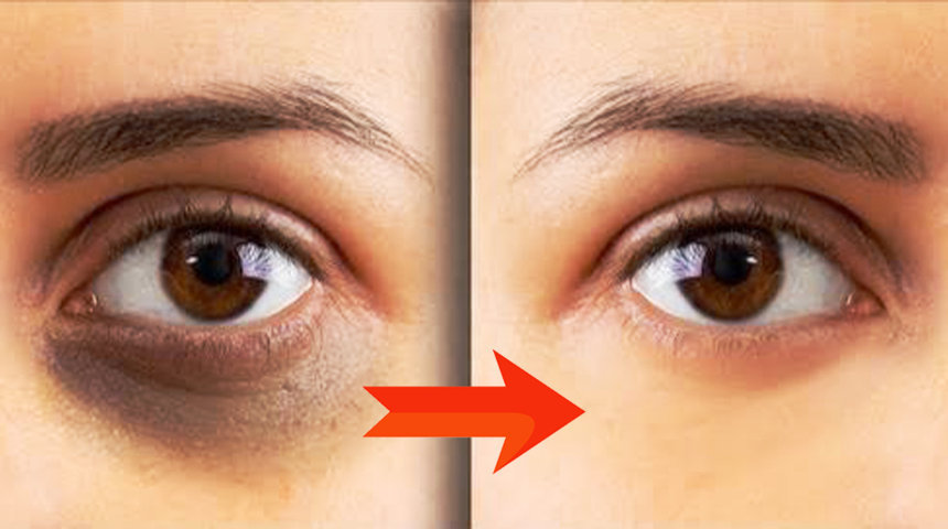 সহজে দূর করুন চোখের নিচের কালো দাগ। - বাংলা জগত