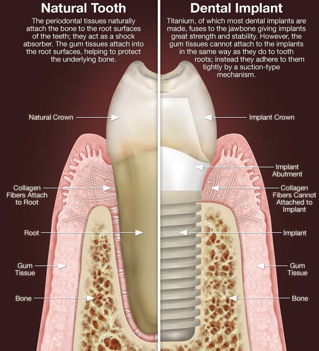 Best Dental Implants Spe****t in Lewisville & The Colony Tx