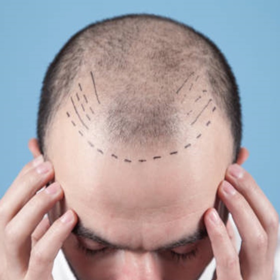 Best Hair Transplant Surgeon in Delhi and Gurgaon