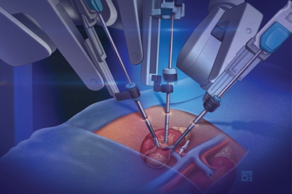 How to Know Everything About Robotic Surgery for Kidney Cancer Treatment - sparkypost.online