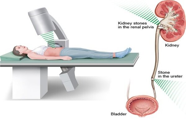 Kidney Stone Surgery: Understanding the Process, Treatment Options, and Recovery -