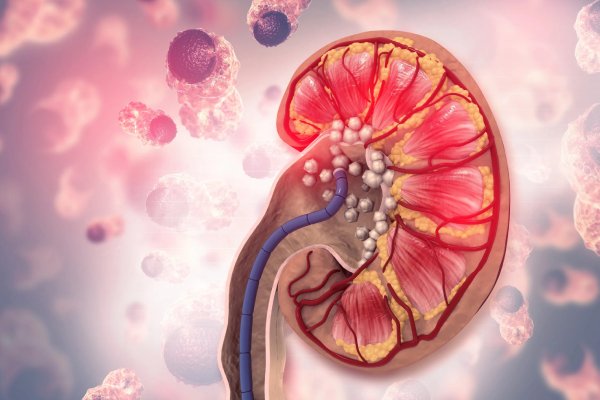 Understanding About the Best Kidney Stone Surgery Treatment - Popular Papers