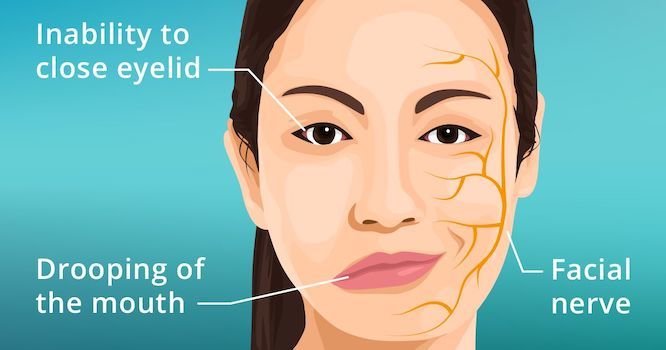 Bell’s Palsy: What It Is, Causes, Symptoms & Treatment