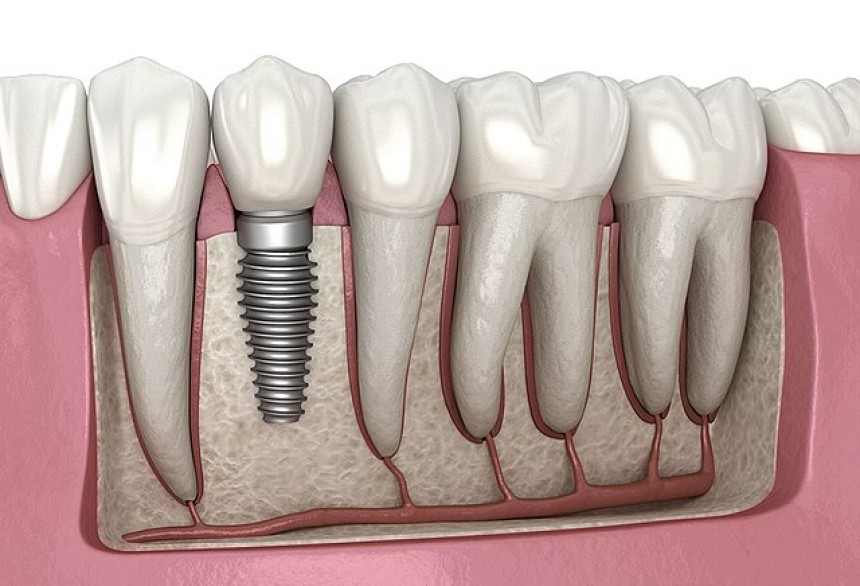 Blogs - Bang Box online - Healing After Dental Implants: Recovery Timeline & Tips