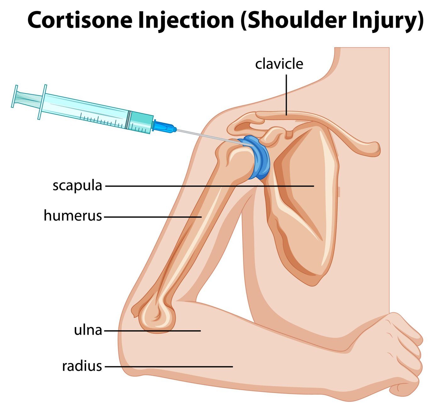 Cortisone Injections For Shoulder Impingement: Are They Worth It?