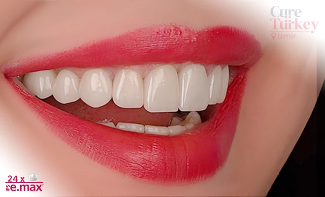 Is it a Good Idea to Get Veneers in Turkey? – TeamCnut