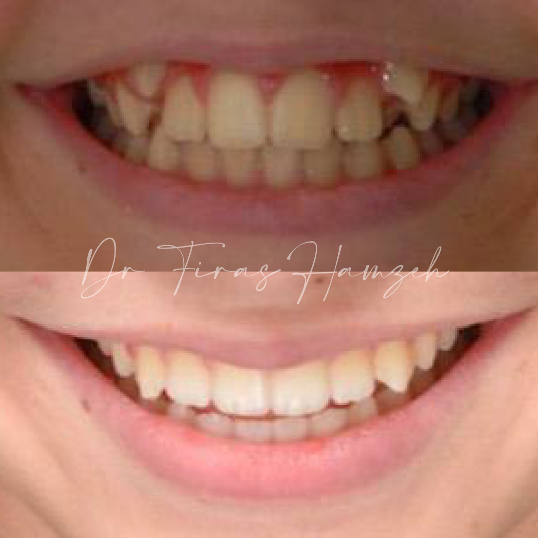 Spark Clear Aligners Treatment in Dubai