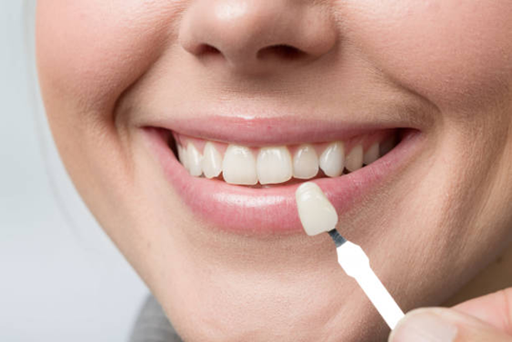 How Dental Veneers Improve Your Confidence and Appearance - Al Qudwah